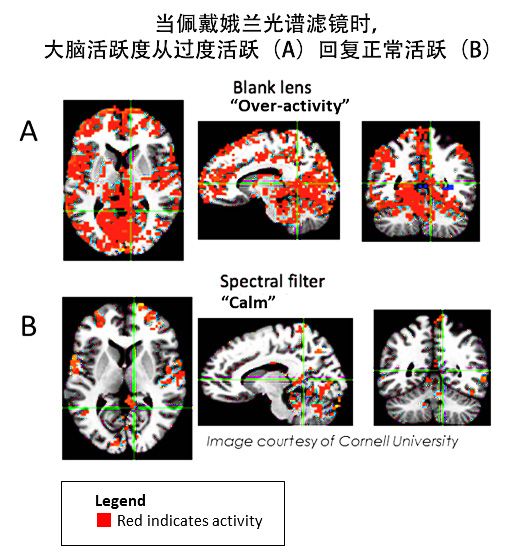 当佩戴娥兰光谱滤镜时 大脑活跃度从过度活跃（A）回复正常活跃（B）